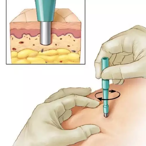 Игла для биопсии кожи Dermo Punch 6мм DMP06